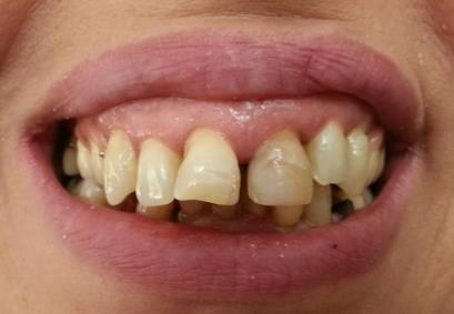 Sorrisi gengivali - Estetica dentale - Laboratorio Smile a Bergamo